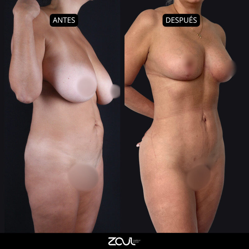 Senos + abdomen - Dra Carolina Hoyos