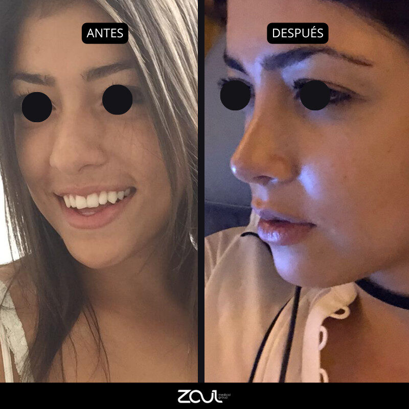 Rinoplastia - Dra Carolina Hoyos