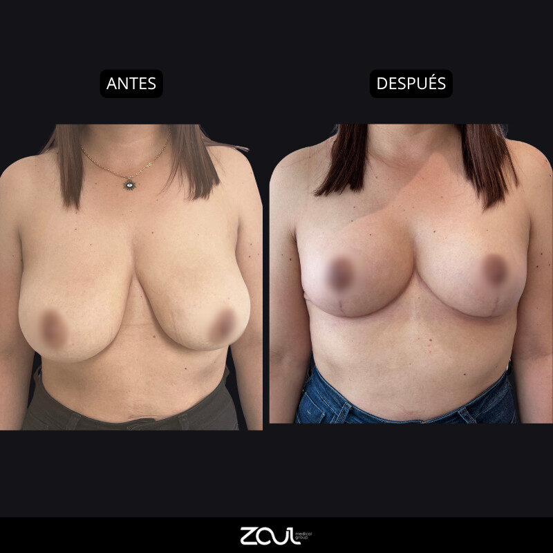 Mamoplastia de reducción - Dra Carolina Hoyos