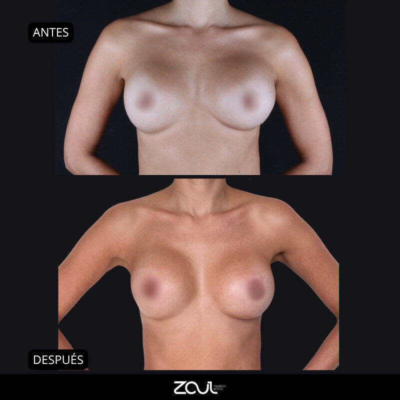 Mastopexia (lifting mamario o levantamiento) - Dra Carolina Hoyos