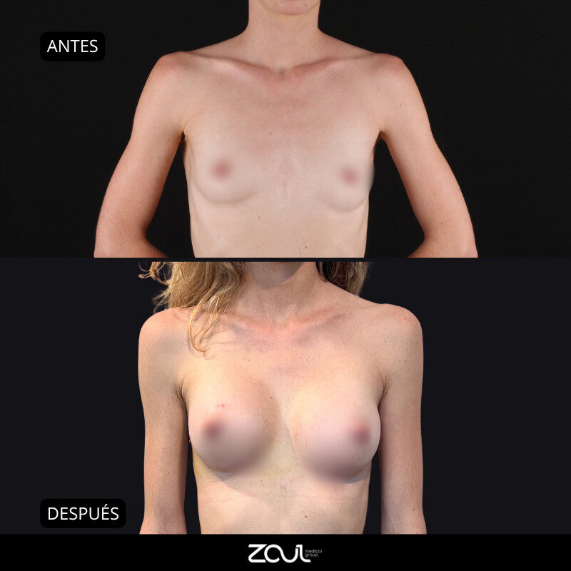 Mamoplastia de aumento con implantes Ergonomix - Dra Carolina Hoyos