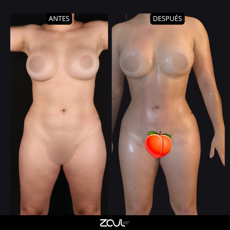 Beach body (lipoescultura + cirugía mamaria) - Dra Carolina Hoyos