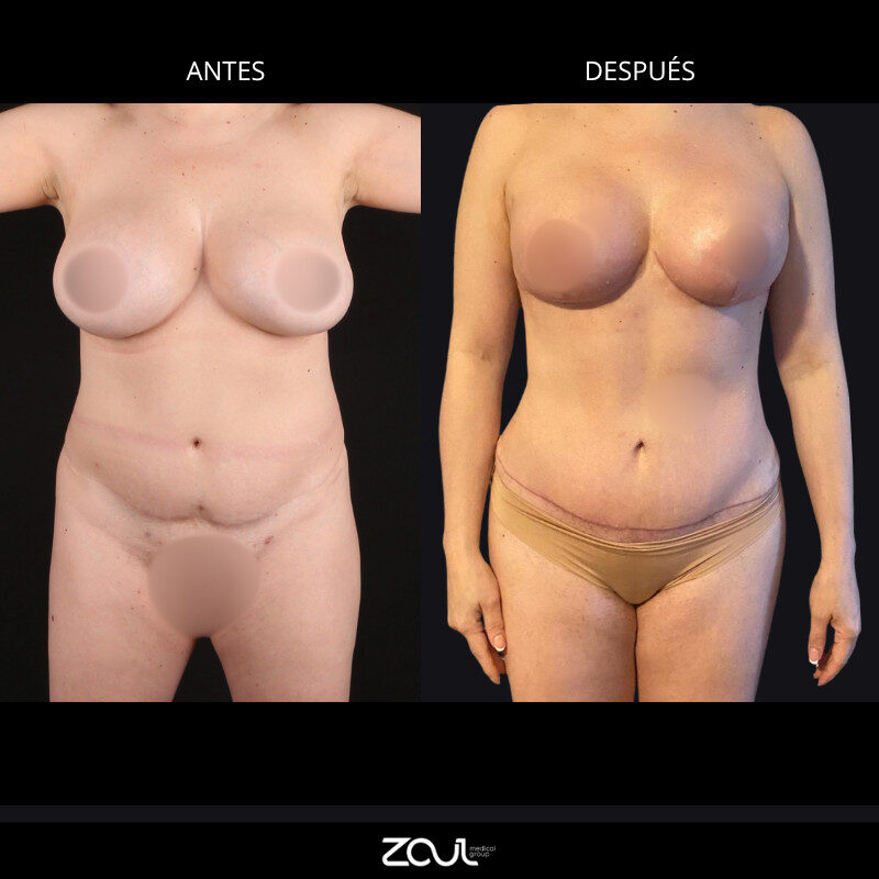 Mommy makeover (mastopexia + lipoabdominoplastia) - Dra Carolina Hoyos