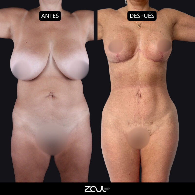 Senos + abdomen - Dra Carolina Hoyos