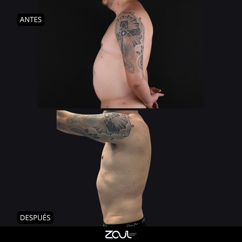 Abdominoplastia (reconstrucción de pared abdominal) - Dra Carolina Hoyos