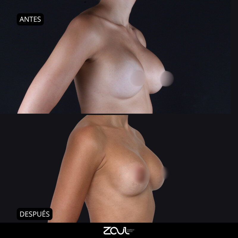 Mastopexia (lifting mamario o levantamiento) - Dra Carolina Hoyos
