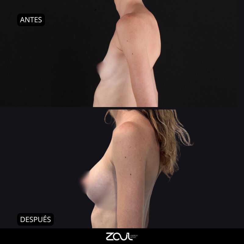 Mamoplastia de aumento con implantes Ergonomix - Dra Carolina Hoyos