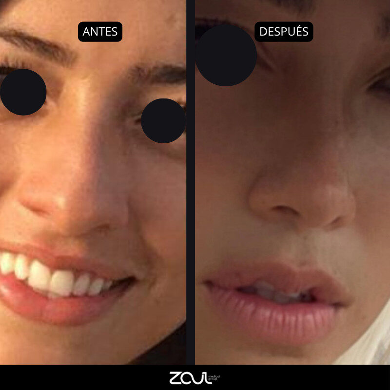 Rinoplastia - Dra Carolina Hoyos