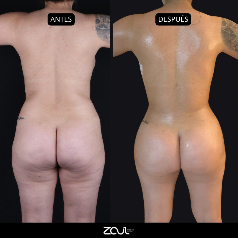 Beach body (lipoescultura + cirugía mamaria) - Dra Carolina Hoyos