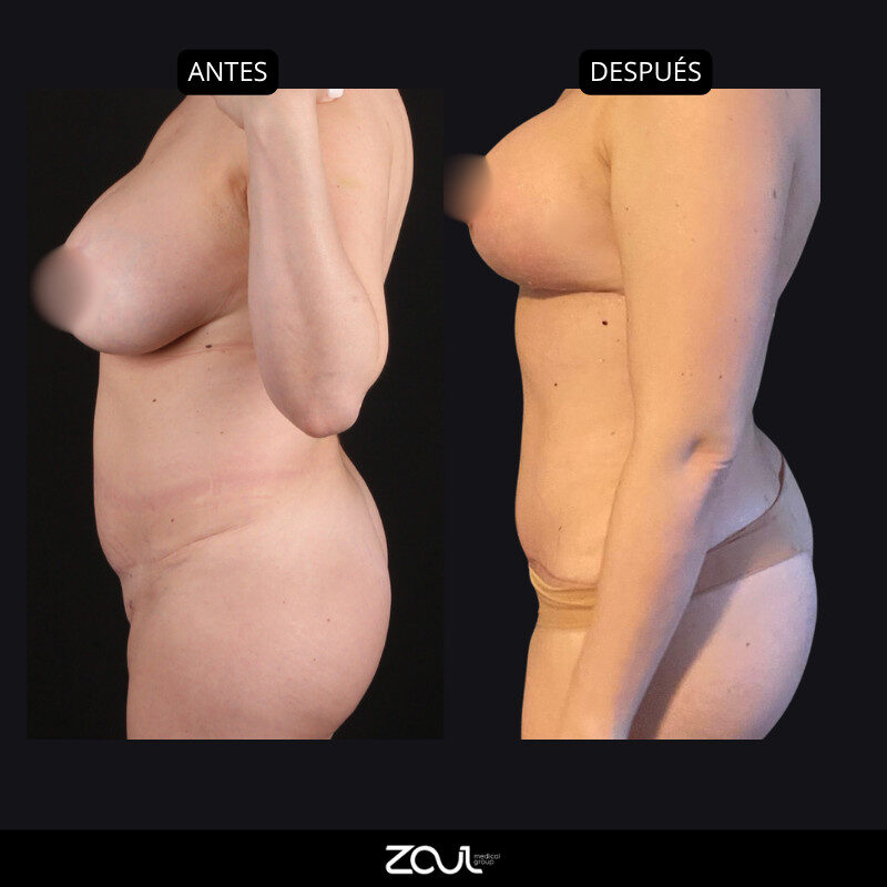 Mommy makeover (mastopexia + lipoabdominoplastia) - Dra Carolina Hoyos