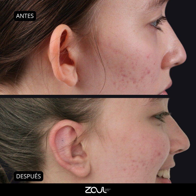Otoplastia - Dra Carolina Hoyos