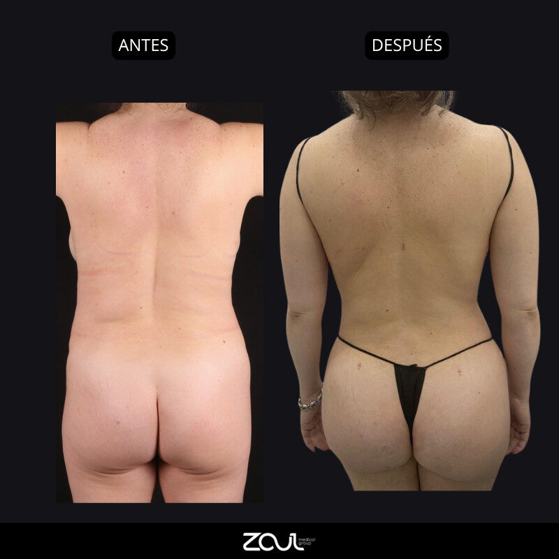 Mommy makeover (mastopexia + lipoabdominoplastia) - Dra Carolina Hoyos