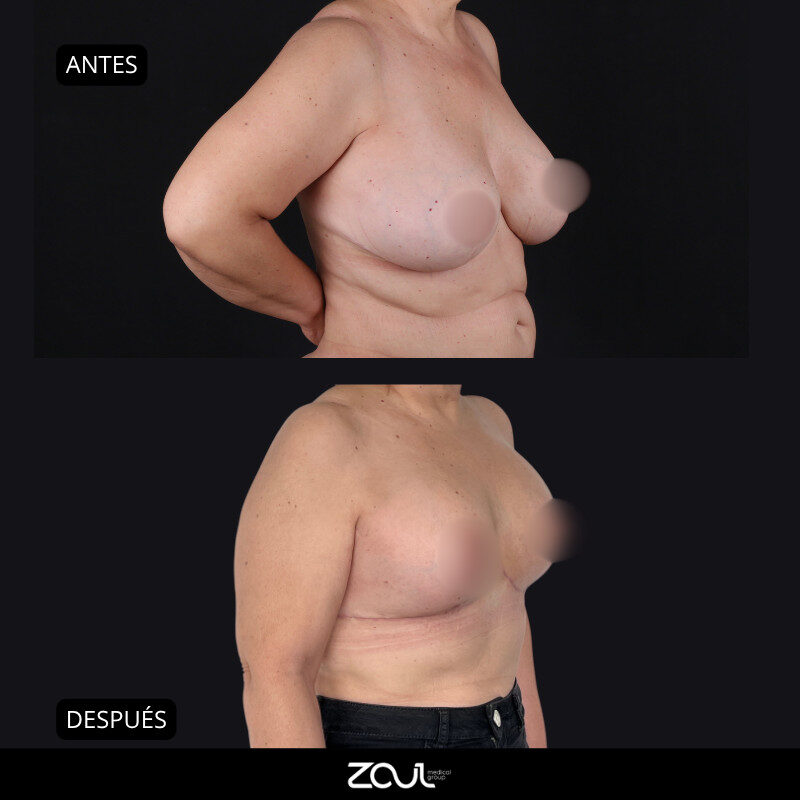 Senos + abdomen - Dra Carolina Hoyos