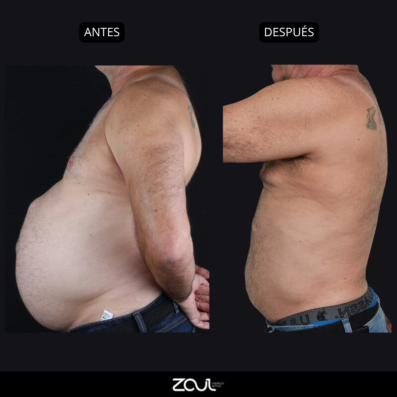 Abdominoplastia (reconstrucción de pared abdominal) - Dra Carolina Hoyos