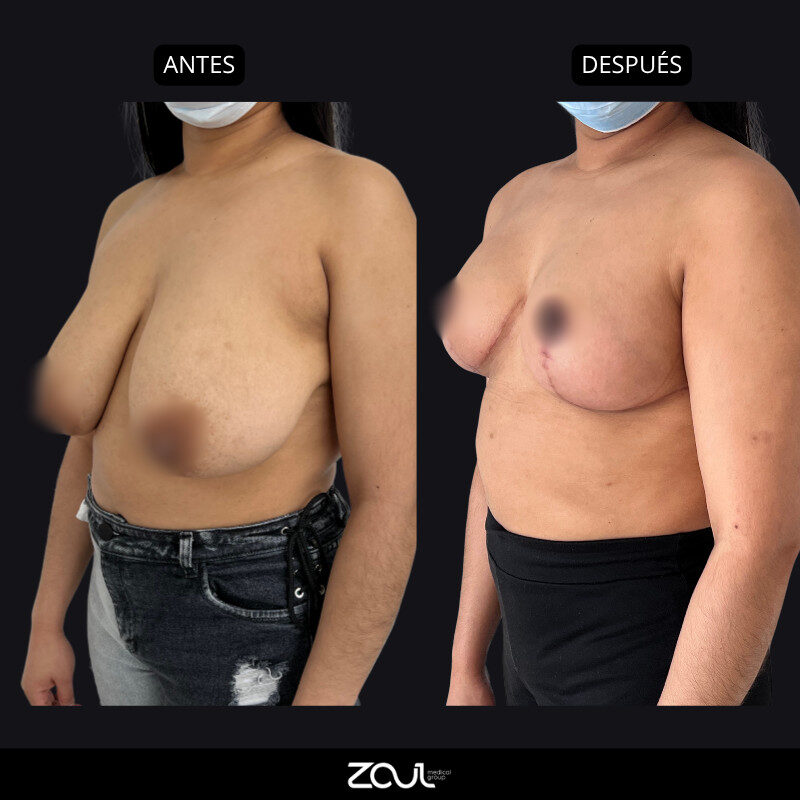 Mamoplastia de reducción - Dra Carolina Hoyos