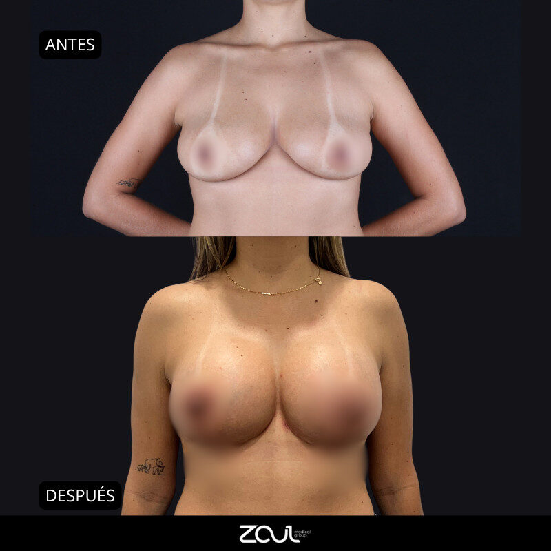 Mastopexia (lifting mamario o levantamiento) - Dra Carolina Hoyos