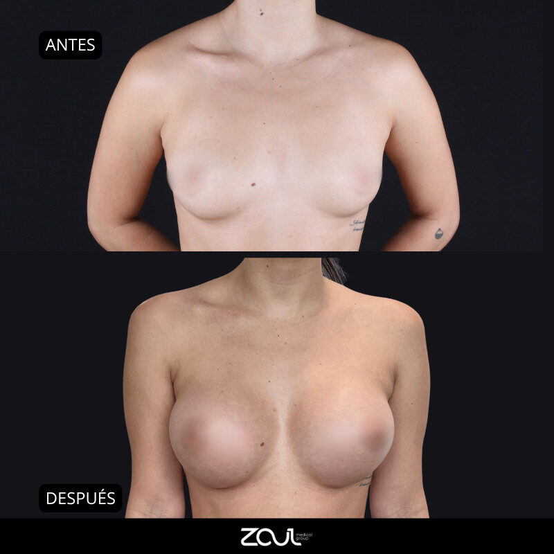 Mamoplastia de aumento con implantes Ergonomix - Dra Carolina Hoyos