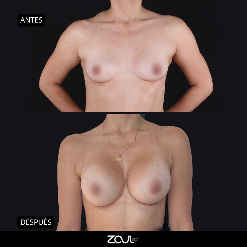 Mamoplastia de aumento con implantes redondos - Dra Carolina Hoyos