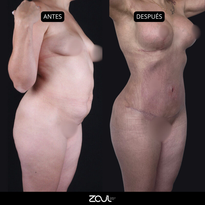 Mommy makeover (mastopexia + lipoabdominoplastia) - Dra Carolina Hoyos