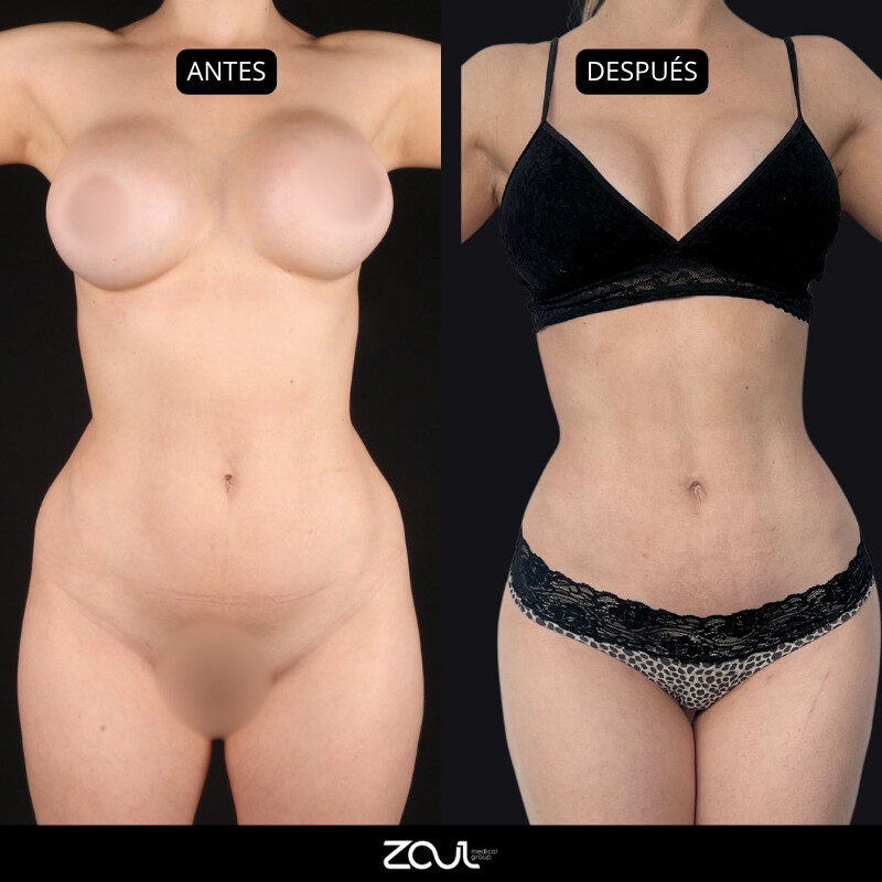Lipoescultura y lipotransferencia - Dra Carolina Hoyos