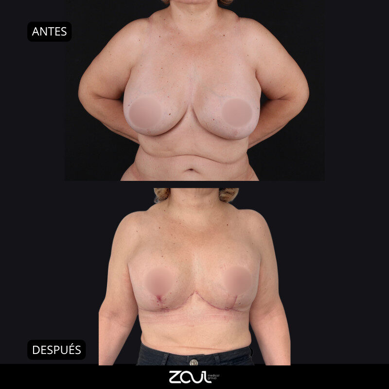 Senos + abdomen - Dra Carolina Hoyos