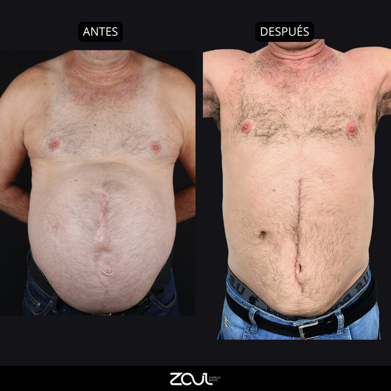 Abdominoplastia (reconstrucción de pared abdominal) - Dra Carolina Hoyos