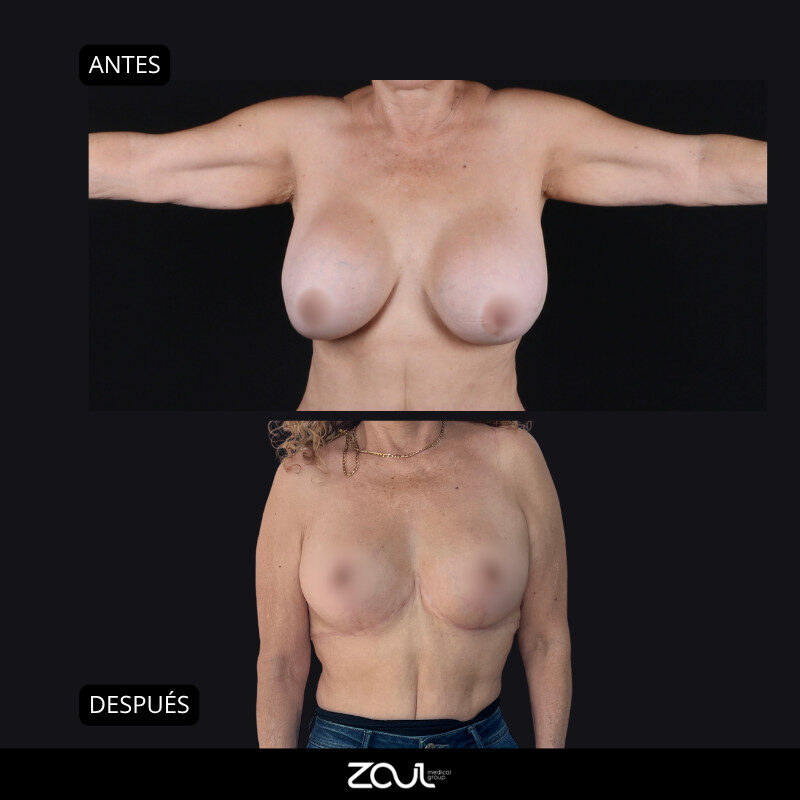 Explantación y reconstrucción mamaria - Dra Carolina Hoyos