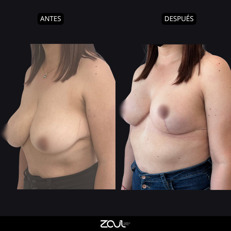 Mamoplastia de reducción - Dra Carolina Hoyos