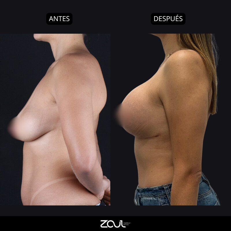 Mastopexia (lifting mamario o levantamiento) - Dra Carolina Hoyos