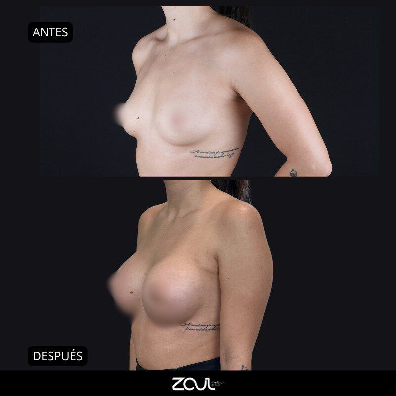 Mamoplastia de aumento con implantes Ergonomix - Dra Carolina Hoyos