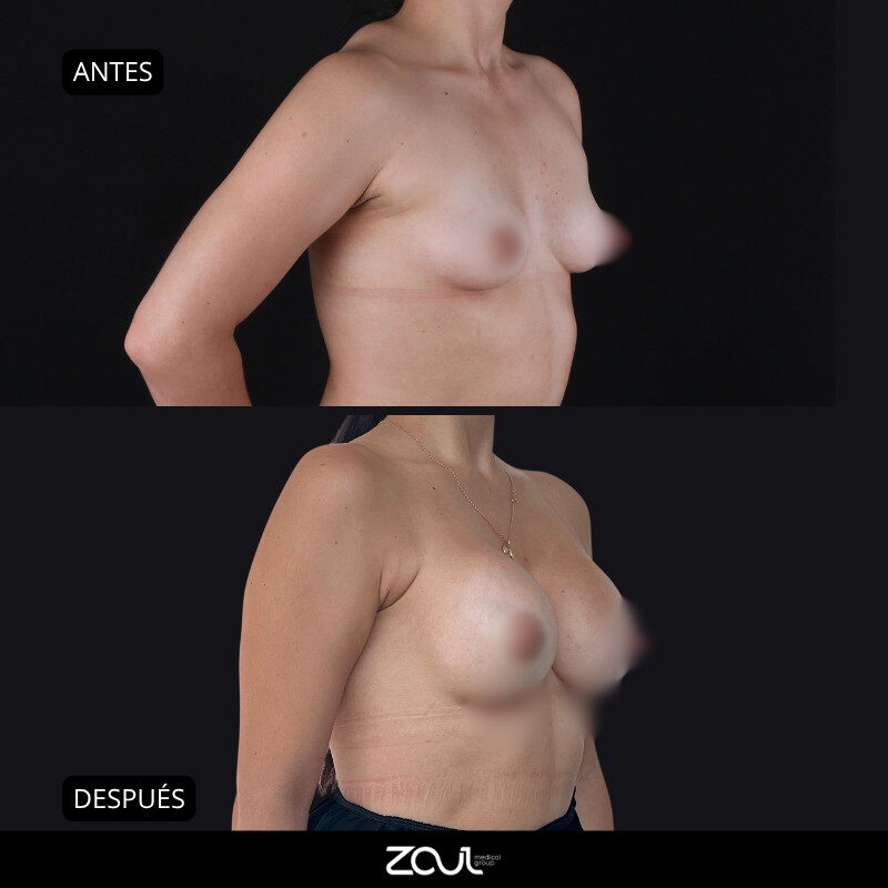 Mamoplastia de aumento con implantes redondos - Dra Carolina Hoyos