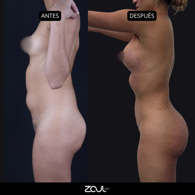 Beach body (lipoescultura + cirugía mamaria) - Dra Carolina Hoyos