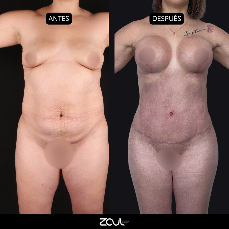 Mommy makeover (mastopexia + lipoabdominoplastia) - Dra Carolina Hoyos