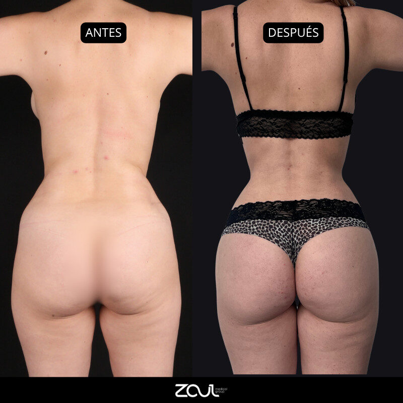 Lipoescultura y lipotransferencia - Dra Carolina Hoyos