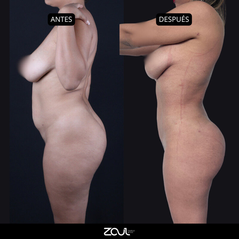 Retraction (flacidez) - Dra Carolina Hoyos