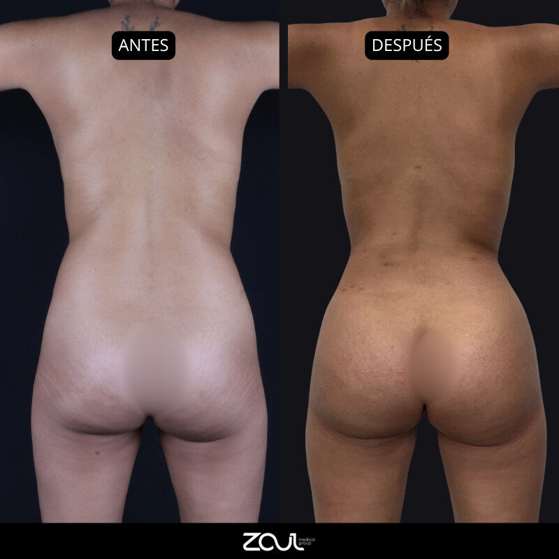 Beach body (lipoescultura + cirugía mamaria) - Dra Carolina Hoyos