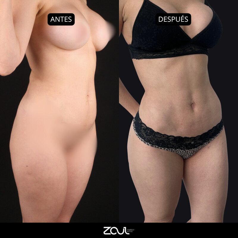 Lipoescultura y lipotransferencia - Dra Carolina Hoyos