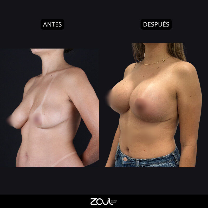 Mastopexia (lifting mamario o levantamiento) - Dra Carolina Hoyos