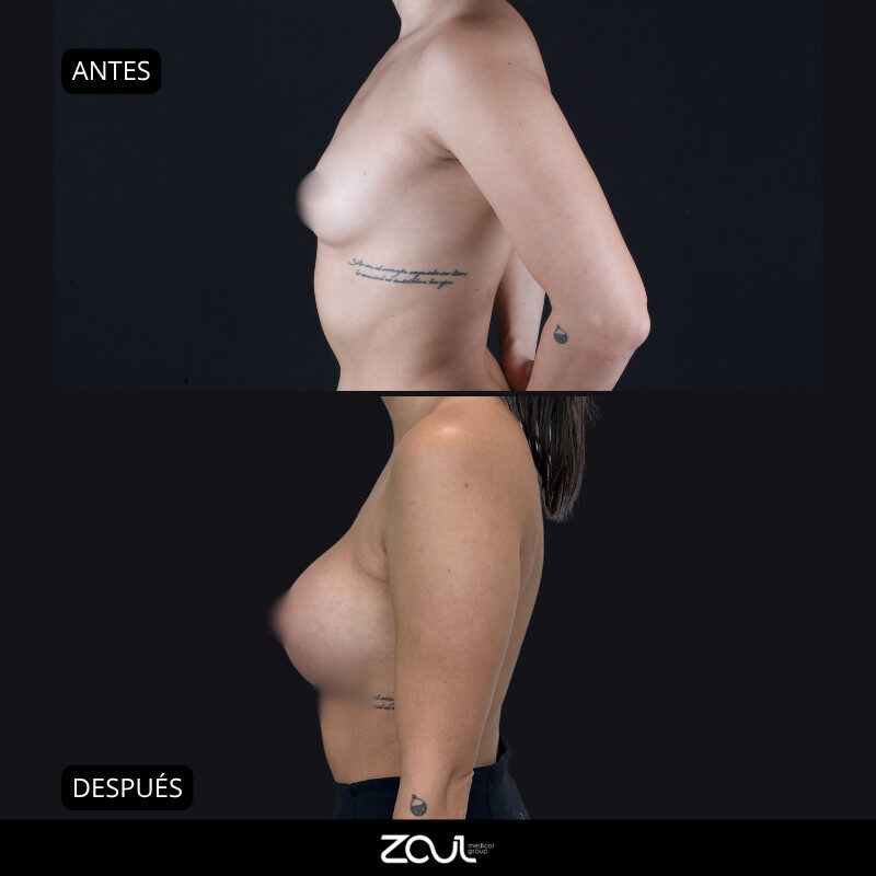 Mamoplastia de aumento con implantes Ergonomix - Dra Carolina Hoyos