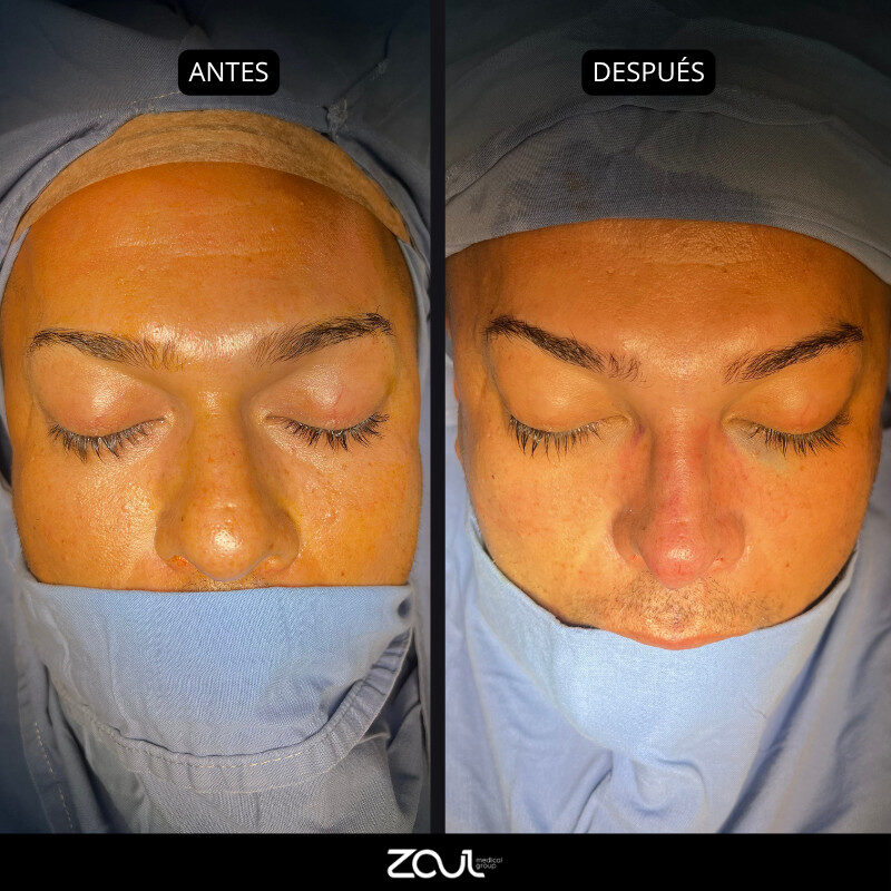 Rinoplastia - Dra Carolina Hoyos