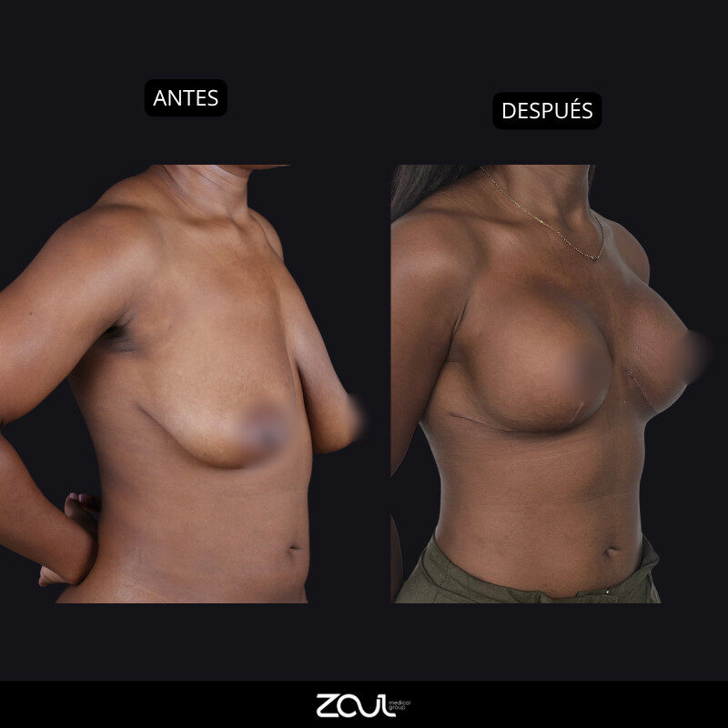Mastopexia (lifting mamario o levantamiento) - Dra Carolina Hoyos