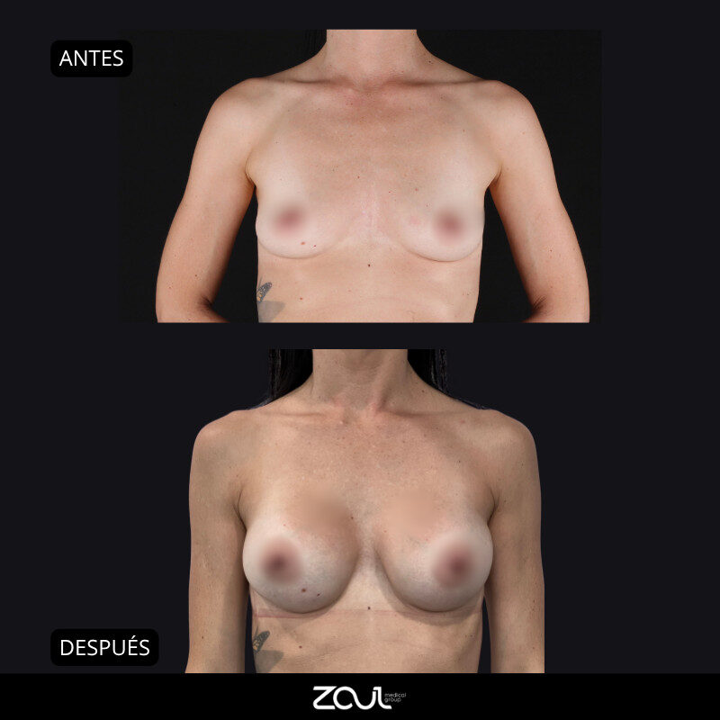 Mamoplastia de aumento con implantes Ergonomix - Dra Carolina Hoyos