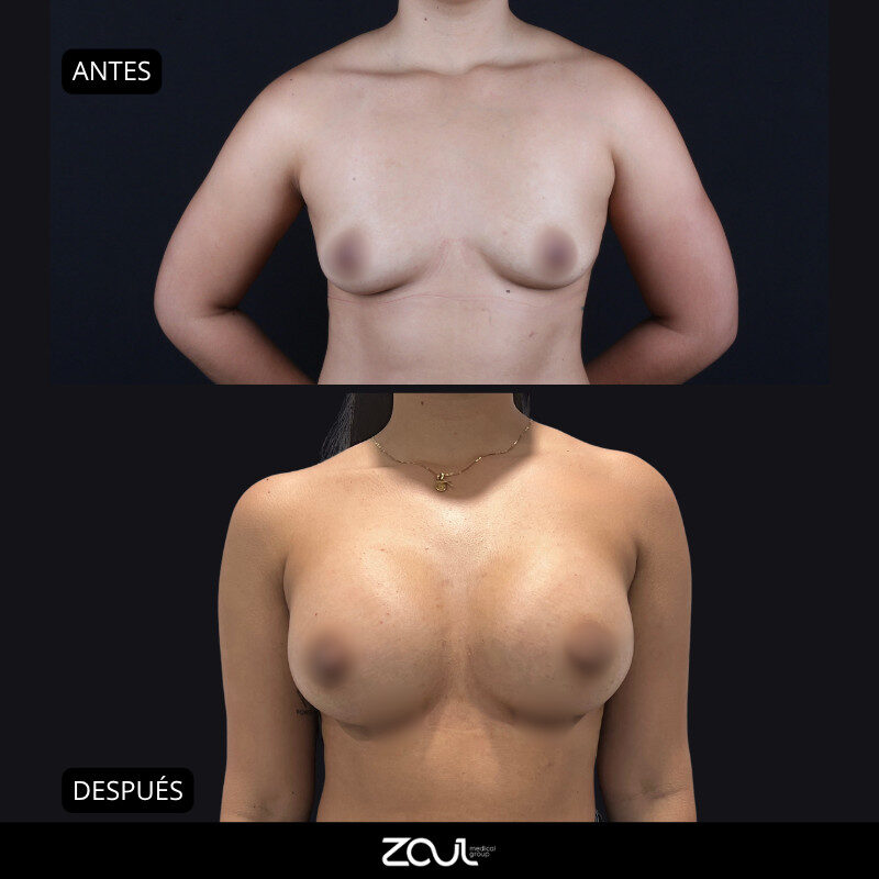 Mamoplastia de aumento con implantes redondos - Dra Carolina Hoyos