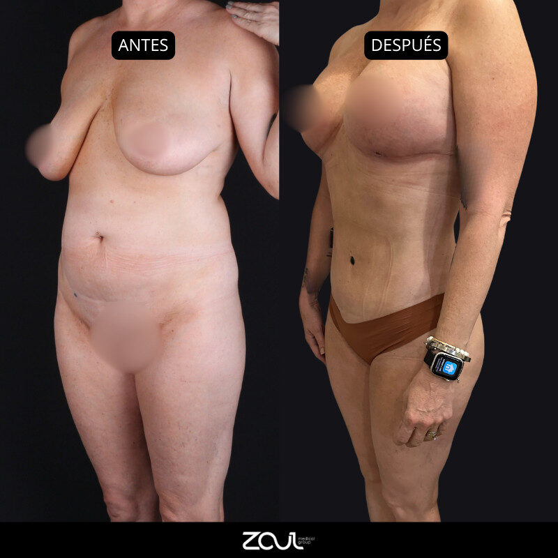 Mommy makeover (mastopexia + lipoabdominoplastia) - Dra Carolina Hoyos