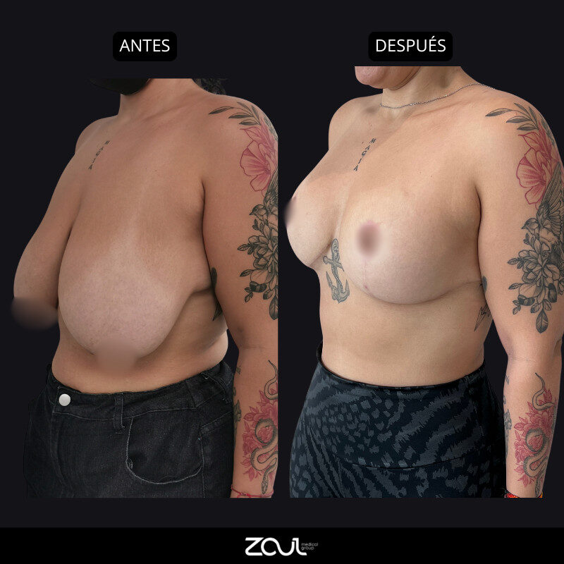 Mamoplastia de reducción - Dra Carolina Hoyos