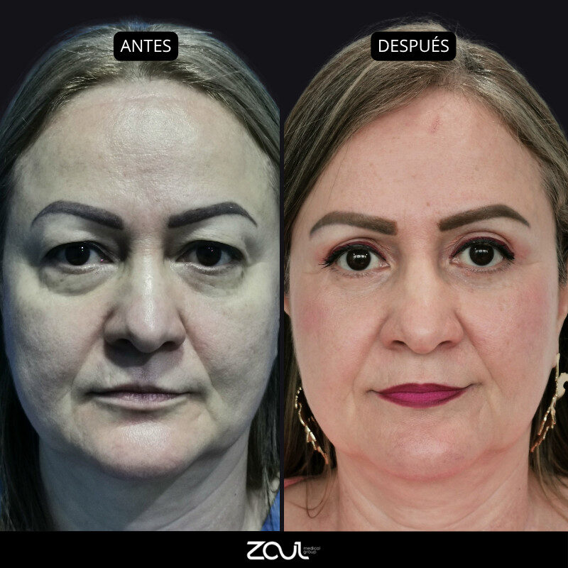 Rejuvenecimiento orbitario - Dra Carolina Hoyos