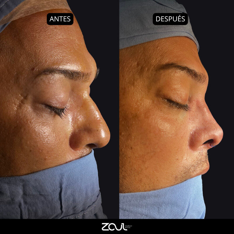 Rinoplastia - Dra Carolina Hoyos