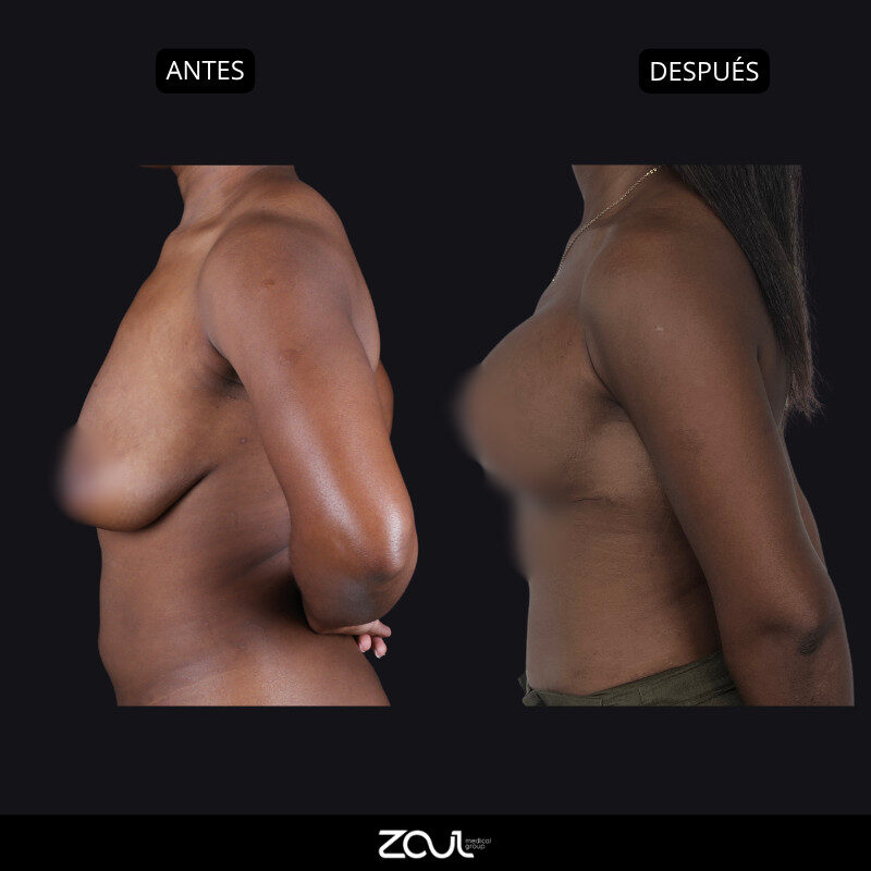 Mastopexia (lifting mamario o levantamiento) - Dra Carolina Hoyos
