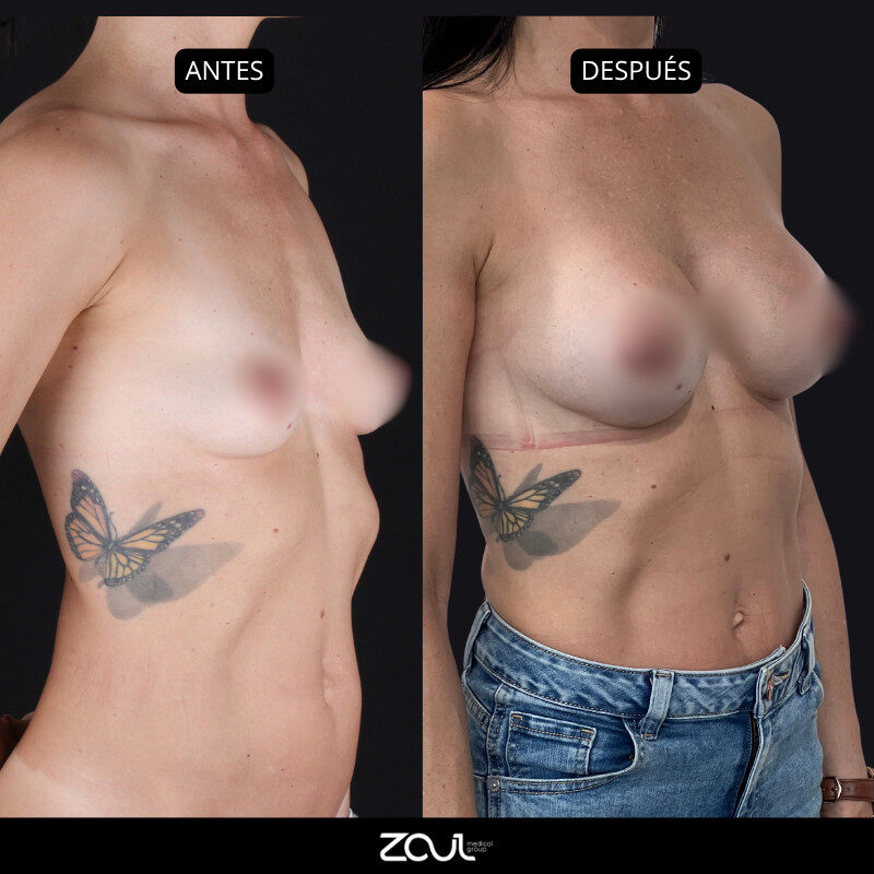 Mamoplastia de aumento con implantes Ergonomix - Dra Carolina Hoyos
