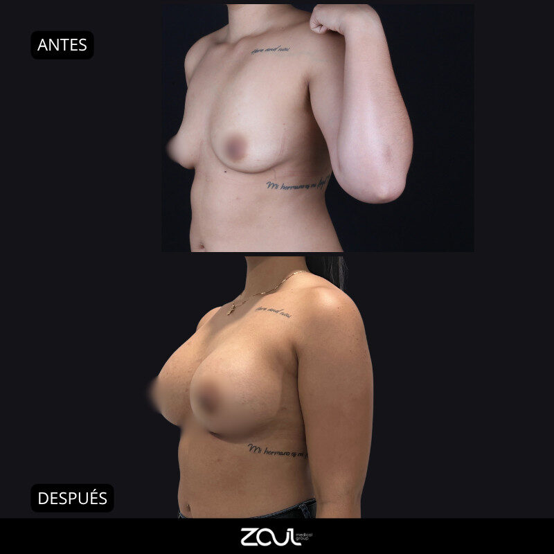 Mamoplastia de aumento con implantes redondos - Dra Carolina Hoyos